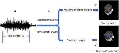 Pretreatment Source Location and Functional Connectivity Network Correlated With Therapy Response in Childhood Absence Epilepsy: A Magnetoencephalography Study